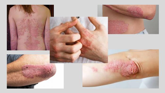 IVERMECTINA e PSORÍASE, DERMATITES e DERMATOSES