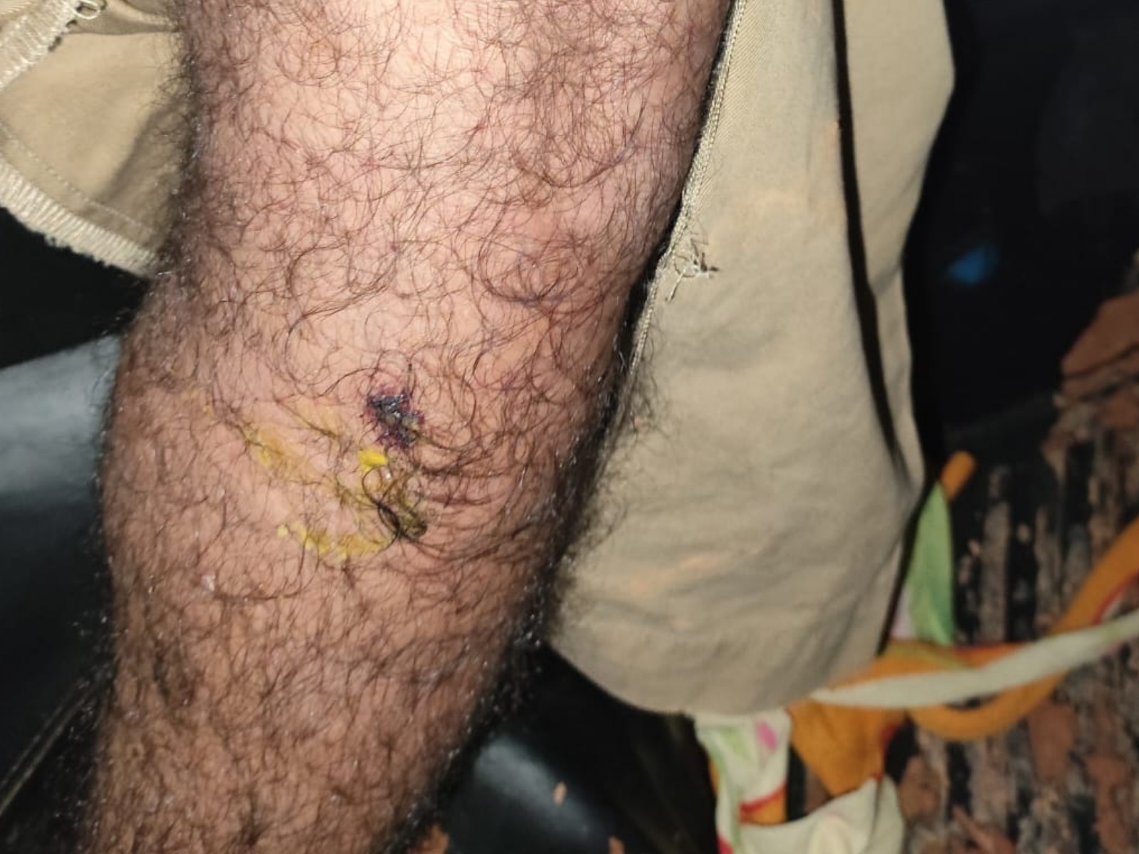 Homem é resgatado após ser picado por cobra na perna durante caça no interior do Acre; VÍDEO