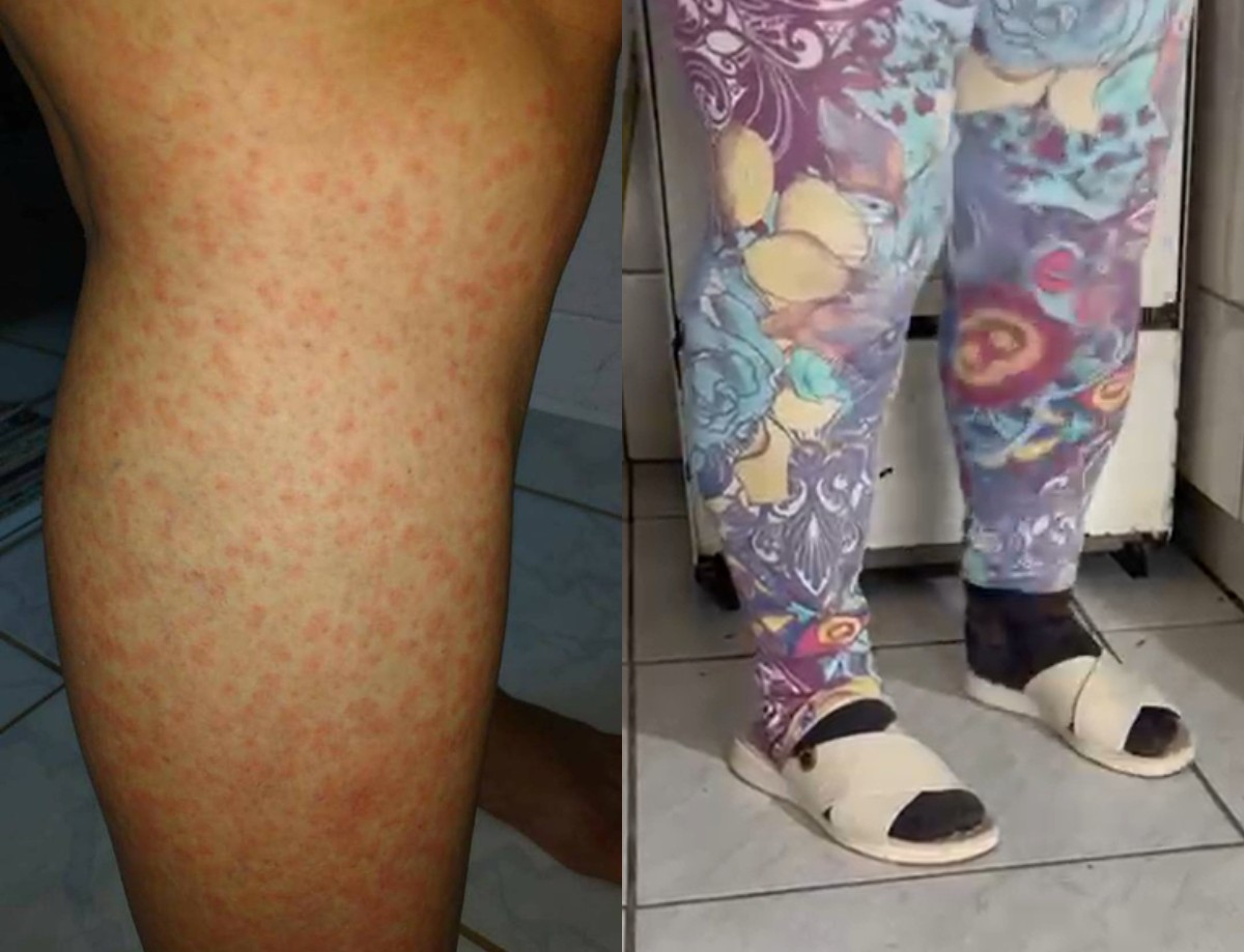 Cidade de SC com infestação de mosquitos busca produto experimental para controlar o inseto; entenda