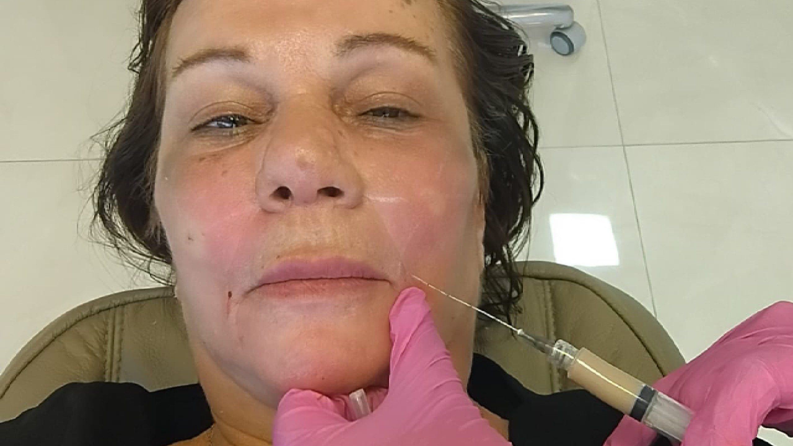 Estudante de biomedicina é denunciado por procedimento estético irregular que causou morte de idosa em Curitiba