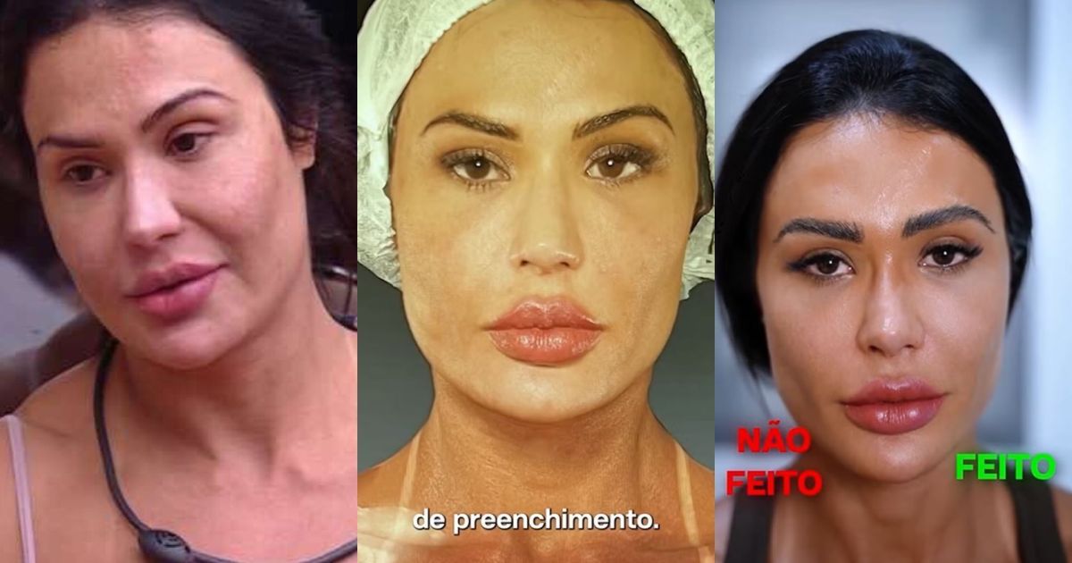 Gracyanne, Kerline e mais: veja ex-BBBs que reverteram procedimentos