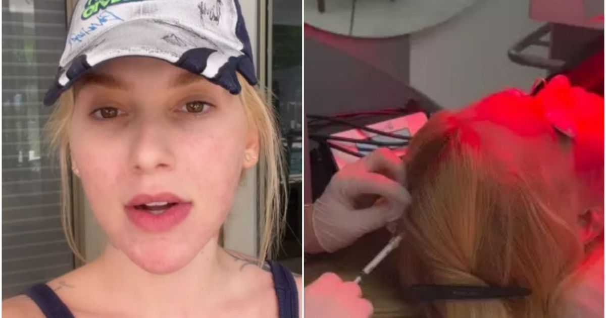 Virginia revela diagnóstico de alopecia areata e faz desabafo