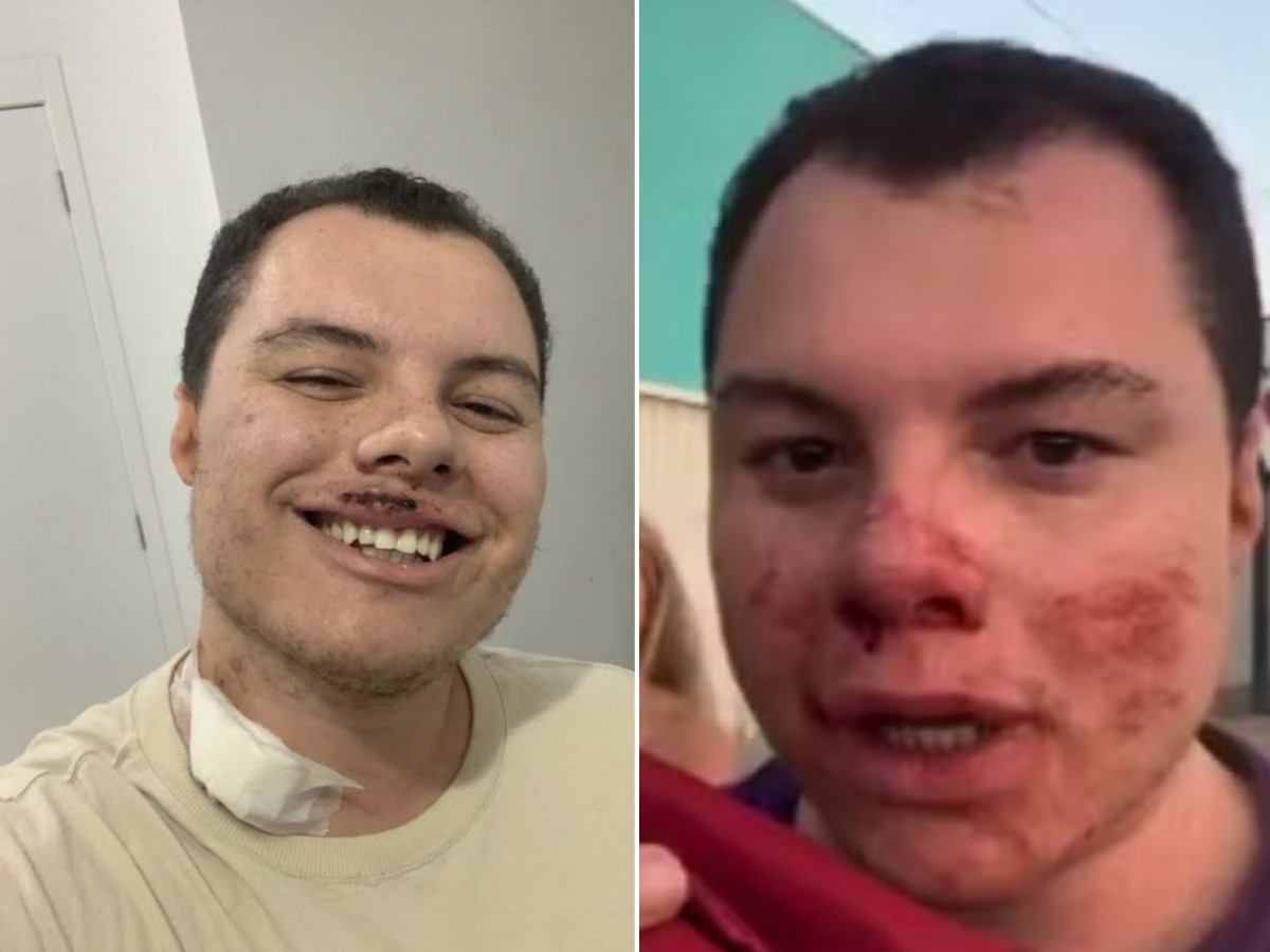 Influenciador agredido por estudantes em festa universitária recebe alta do hospital: 'foram seis dias entre a vida e a morte'