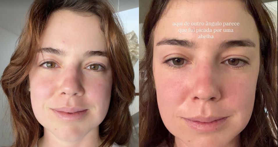 Alice Wegmann revela procedimento recente e mostra inchaço do rosto