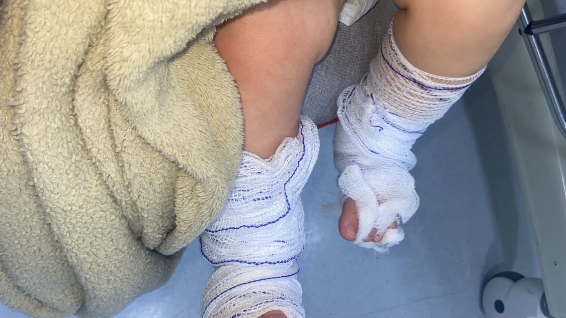 Bebê de 11 meses tem queimaduras de 2º grau após banho em escola no RS, diz mãe; polícia investiga o caso