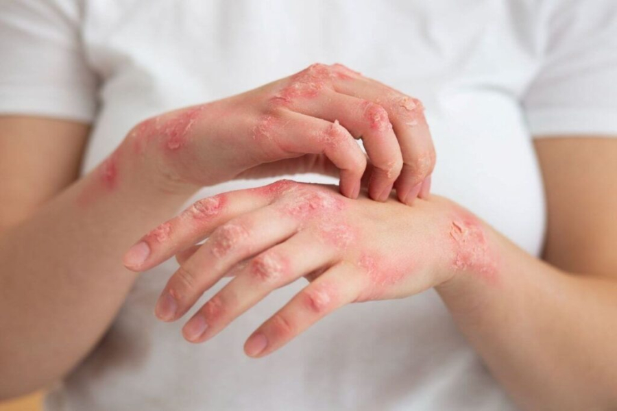 IVERMECTINA e PSORÍASE, DERMATITES e DERMATOSES