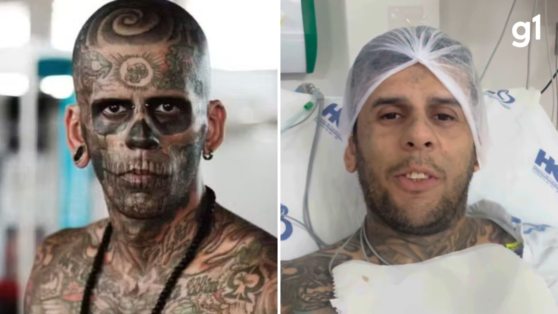 Câncer de bexiga invasivo: entenda tratamento e prognóstico de doença que atinge ‘homem mais tatuado do Brasil’